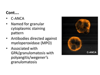 Cont….
• C-ANCA
• Named for granular
cytoplasmic staining
pattern
• Antibodies directed against
myeloperoxidase (MPO)
• Associated with
GPA/granulomatosis with
polyangitis/wegener’s
granulomatosis
 