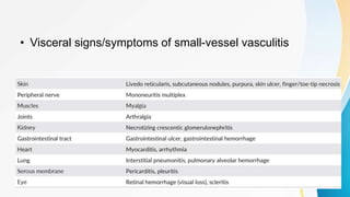 • Visceral signs/symptoms of small-vessel vasculitis
 