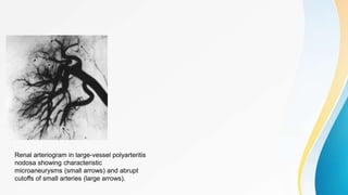 Renal arteriogram in large-vessel polyarteritis
nodosa showing characteristic
microaneurysms (small arrows) and abrupt
cutoffs of small arteries (large arrows).
 