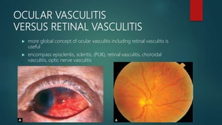 OCULAR VASCULITIS
VERSUS RETINAL VASCULITIS
 more global concept of ocular vasculitis including retinal vasculitis is
useful
 encompass episcleritis, scleritis, (PUK), retinal vasculitis, choroidal
vasculitis, optic nerve vasculitis
 