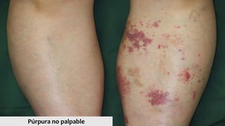 Púrpura no palpable
 