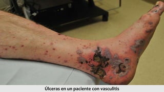Úlceras en un paciente con vasculitis
 