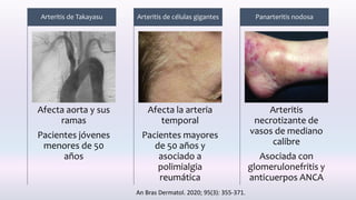 Afecta aorta y sus
ramas
Pacientes jóvenes
menores de 50
años
Arteritis de Takayasu
Afecta la arteria
temporal
Pacientes mayores
de 50 años y
asociado a
polimialgia
reumática
Arteritis de células gigantes
Arteritis
necrotizante de
vasos de mediano
calibre
Asociada con
glomerulonefritis y
anticuerpos ANCA
Panarteritis nodosa
An Bras Dermatol. 2020; 95(3): 355-371.
 