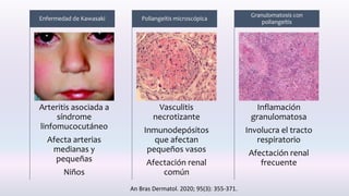 Arteritis asociada a
síndrome
linfomucocutáneo
Afecta arterias
medianas y
pequeñas
Niños
Enfermedad de Kawasaki
Vasculitis
necrotizante
Inmunodepósitos
que afectan
pequeños vasos
Afectación renal
común
Poliangeítis microscópica
Inflamación
granulomatosa
Involucra el tracto
respiratorio
Afectación renal
frecuente
Granulomatosis con
poliangeítis
An Bras Dermatol. 2020; 95(3): 355-371.
 