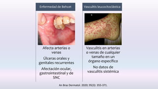 Afecta arterias o
venas
Úlceras orales y
genitales recurrentes
Afectación ocular,
gastrointestinal y de
SNC
Enfermedad de Behcet
Vasculitis en arterias
o venas de cualquier
tamaño en un
órgano específico
No datos de
vasculitis sistémica
Vasculitis leucocitoclástica
An Bras Dermatol. 2020; 95(3): 355-371.
 
