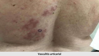 Vasculitis urticarial
 