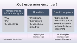 ¿Qué esperamos encontrar?
Marcadores de
inflamación aguda
•VSG
•PCR
•Leucocitosis
Urianálisis
•Proteinuria
•Eritrocituria
•Leucocituria
•Cilindros
Química sanguínea
•Elevación de
creatinina y BUN
•Disminución del
aclaramiento de
creatinina
En poliangeítis
microscópica
En poliangeítis
microscópica y
panarteritis nodosaJ Gen Fam Med. 2017;18:72–78
 