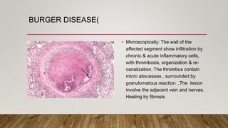 BURGER DISEASE(
• Microscopically: The wall of the
affected segment show infiltration by
chronic & acute inflammatory cells,
with thrombosis, organization & re-
canalization. The thrombus contain
micro abscesses , surrounded by
granulomatous reaction .,The lesion
involve the adjacent vein and nerves.
Healing by fibrosis
 