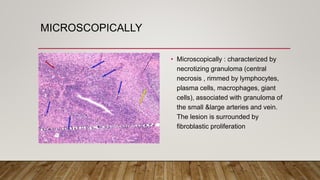 MICROSCOPICALLY
• Microscopically : characterized by
necrotizing granuloma (central
necrosis , rimmed by lymphocytes,
plasma cells, macrophages, giant
cells), associated with granuloma of
the small &large arteries and vein.
The lesion is surrounded by
fibroblastic proliferation
 