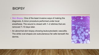 BIOPSY
• Skin Biopsy: One of the least invasive ways of making the
diagnosis. A minor procedure performed under local
anesthesia. The wound is closed with 1–2 stitches that are
removed 7–10 days later.
• An abnormal skin biopsy showing leukocytoclastic vasculitis.
The white oval shapes are subcutaneous fat cells beneath the
dermis.
 