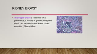 KIDNEY BIOPSY
• This biopsy shows a “crescent” in a
glomerulus, a feature of glomerulonephritis
which can be seen in ANCA-associated
vasculitis (GPA or MPA).
 
