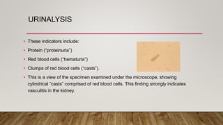 URINALYSIS
• These indicators include:
• Protein (“proteinuria”)
• Red blood cells (“hematuria”)
• Clumps of red blood cells (“casts”).
• This is a view of the specimen examined under the microscope, showing
cylindrical “casts” comprised of red blood cells. This finding strongly indicates
vasculitis in the kidney.
 