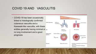 COVID 19 AND VASCULITIS
• COVID-19 has been occasionally
linked to histologically confirmed
cutaneous vasculitis and a
Kawasaki-like vasculitis, with these
entities generally having minimal or
no lung involvement and a good
prognosis
 