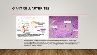 GIANT CELL ARTERITES
• Microscopically the lesion consist of granulomatous lesion consisting of lymphocytes,
macrophages, giant cellsneutrophils &esinophils at the inner third of the media ,.The lesion
is centered at the internal elastic lamina,which is fragmented.It is cell mediated immune
response to unkown antigrn.
 