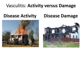 Vasculitis: Activity versus Damage
Disease Activity Disease Damage
 