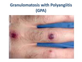 Granulomatosis with Polyangiitis
(GPA)
 