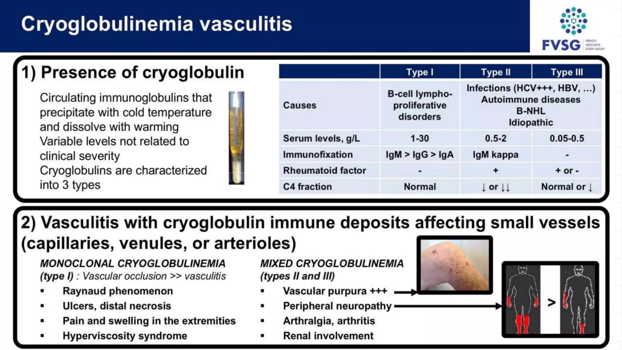 Vasculitis pptx Vasculitis pptx