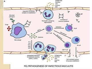 FIG: PATHOGENESIS OF INFECTIOUSVASCULITIS
 