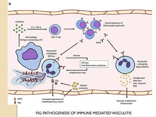 FIG: PATHOGENESIS OF IMMUNE MEDIATEDVASCULITIS
 