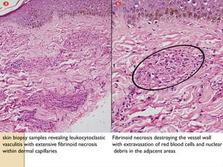 skin biopsy samples revealing leukocytoclastic
vasculitis with extensive fibrinoid necrosis
within dermal capillaries
Fibrinoid necrosis destroying the vessel wall
with extravasation of red blood cells and nuclear
debris in the adjacent areas
 