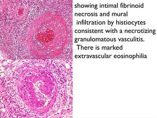 showing intimal fibrinoid
necrosis and mural
infiltration by histiocytes
consistent with a necrotizing
granulomatous vasculitis.
There is marked
extravascular eosinophilia.
 