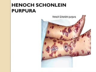 HENOCH SCHONLEIN
PURPURA
 