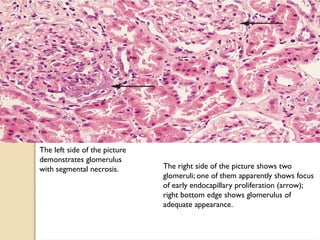 The left side of the picture
demonstrates glomerulus
with segmental necrosis. The right side of the picture shows two
glomeruli; one of them apparently shows focus
of early endocapillary proliferation (arrow);
right bottom edge shows glomerulus of
adequate appearance.
 