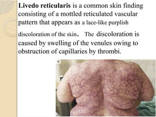 Livedo reticularis is a common skin finding
consisting of a mottled reticulated vascular
pattern that appears as a lace-like purplish
discoloration of the skin. The discoloration is
caused by swelling of the venules owing to
obstruction of capillaries by thrombi.
 