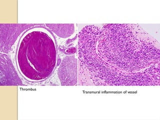 Thrombus
Transmural inflammation of vessel
 