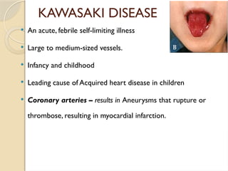 KAWASAKI DISEASE
 An acute, febrile self-limiting illness
 Large to medium-sized vessels.
 Infancy and childhood
 Leading cause of Acquired heart disease in children
 Coronary arteries – results in Aneurysms that rupture or
thrombose, resulting in myocardial infarction.
 