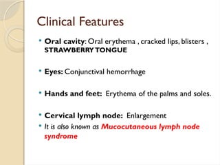 Clinical Features
 Oral cavity: Oral erythema , cracked lips, blisters ,
STRAWBERRYTONGUE
 Eyes: Conjunctival hemorrhage
 Hands and feet: Erythema of the palms and soles.
 Cervical lymph node: Enlargement
 It is also known as Mucocutaneous lymph node
syndrome
 