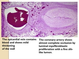 The epicardial vein contains
blood and shows mild
thickening
of the wall
The coronary artery shows
almost complete occlusion by
luminal myofibroblastic
proliferation with a fine slit-
like lumen.
 