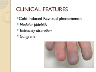 CLINICAL FEATURES
Cold-induced Raynaud phenomenon
 Nodular phlebitis
 Extremity ulceration
 Gangrene
 