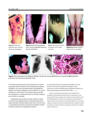 VOL. 14 Núm. 3 - 2007 VASCULITIS DE VASOS PEQUEÑOS
Figura 3.Vasculitis de
pequeños vasos. Lesiones
necróticas y ampollosas.
Figura 4.Vasculitis de pequeños
vasos. Púrpura palpable bilateral y
lesiones necróticas.
Figura 5.Vasculopatía vasculítica
de pequeños vasos. Pápulas
urticariales.
Figura 6.Henoch-Schön-
Púrpura lein en un adulto.
A B do
Figura 7.Granulomatosis de Wegener.A.Nariz de silla de montar.B.Nódulos en el pulmón.DO.Capilaritis
pulmonar en el síndrome pulmón-riñón.
Si el médico presta atención al caso, debe tener en cuenta
que pueden existir limitaciones en la búsqueda de agentes
etiológicos, así como en la especificidad y sensibilidad de
algunos marcadores biológicos como los ANCA-P y C, que se
consideran a continuación. En la mayoría de las vasculitis
leucocitoclásticas, no disponemos de un marcador biológico
para clasificar su etiología.
Se recomienda el ensayo inmunoabsorbente ligado a enzimas
(ELISA) sin fluorescencia y específico de antígeno, ya que
proporciona una alta sensibilidad (aproximadamente el 99%) y una
buena especificidad (aproximadamente el 70%).3-14, 16, 18, 19.
¿Cómo se correlacionan estos efectos in vitro de ANCA con la
actividad de la enfermedad, particularmente en comparación con los
títulos de ANCA? Se ha sugerido que los cambios en varios efectos in vitro
de PR3-ANCA siguen los cambios en la actividad de la enfermedad con
mayor precisión que los cambios en los títulos de ANCA solos.18, pero esta
sugerencia se basa únicamente en observaciones de un pequeño número
de pacientes y, hasta el momento, aún queda por demostrar. Se requiere
mayor elucidación de
El diagnóstico de vasculitis asociada a ANCA se realiza
con base en los hallazgos clínicos, mediante biopsia de un
órgano afectado relevante (típicamente riñón, mucosa nasal
u ocasionalmente pulmón) y la presencia de ANCA. Pruebas
de ANCA mediante inmunoglobulina indirecta...
197
 