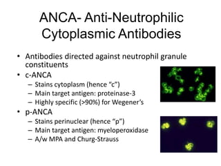 ANCA- Anti-Neutrophilic
Cytoplasmic Antibodies
• Antibodies directed against neutrophil granule
constituents
• c-ANCA
– Stains cytoplasm (hence “c”)
– Main target antigen: proteinase-3
– Highly specific (>90%) for Wegener’s
• p-ANCA
– Stains perinuclear (hence “p”)
– Main target antigen: myeloperoxidase
– A/w MPA and Churg-Strauss
 