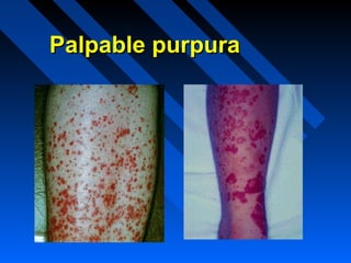 Palpable purpura

 