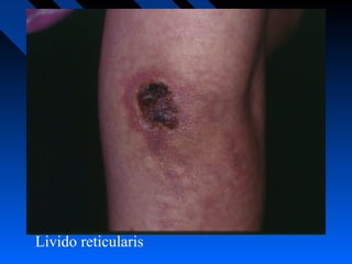 Livido reticularis

 