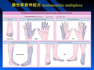 複性單發神經炎 mononeuritis multiplesx

 
