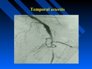 Temporal arteritis

 