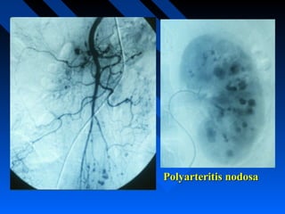 Polyarteritis nodosa

 