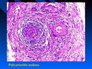 Polyarteritis nodosa

 