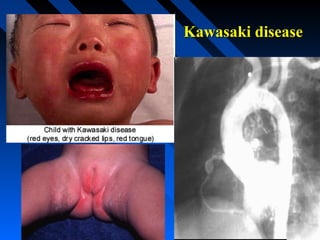 Kawasaki disease

 