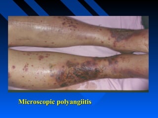 Microscopic polyangiitis

 