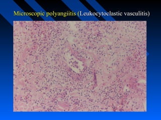 Microscopic polyangiitis (Leukocytoclastic vasculitis)

 