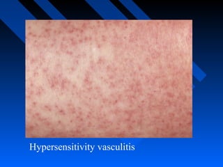 Hypersensitivity vasculitis

 