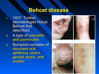 Behcet disease
1.

2.
3.

1937: Turkish
dermatologist Hulusi
Behcet first
described.
A type of vasculitis
and pannivulitis
Symptom-complex of
recurrent oral
aphthous ulcers,
genital ulcers, and
uveitis.

 