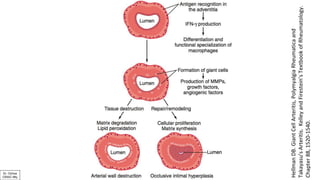 HellmanDB.GiantCellArteritis,PolymyalgiaRheumaticaand
Takayasu’sArteritis.KelleyandFirestein’sTextbookofRheumatology.
Chapter88,1520-1540.
Dr. Ochoa
CRAIC Mty
 