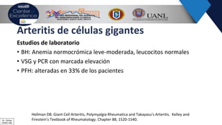 Arteritis de células gigantes
Estudios de laboratorio
• BH: Anemia normocrómica leve-moderada, leucocitos normales
• VSG y PCR con marcada elevación
• PFH: alteradas en 33% de los pacientes
Hellman DB. Giant Cell Arteritis, Polymyalgia Rheumatica and Takayasu’s Arteritis. Kelley and
Firestein’s Textbook of Rheumatology. Chapter 88, 1520-1540.Dr. Ochoa
CRAIC Mty
 
