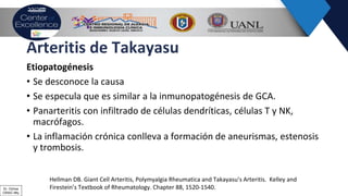 Arteritis de Takayasu
Etiopatogénesis
• Se desconoce la causa
• Se especula que es similar a la inmunopatogénesis de GCA.
• Panarteritis con infiltrado de células dendríticas, células T y NK,
macrófagos.
• La inflamación crónica conlleva a formación de aneurismas, estenosis
y trombosis.
Hellman DB. Giant Cell Arteritis, Polymyalgia Rheumatica and Takayasu’s Arteritis. Kelley and
Firestein’s Textbook of Rheumatology. Chapter 88, 1520-1540.Dr. Ochoa
CRAIC Mty
 