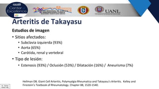 Arteritis de Takayasu
Estudios de imagen
• Sitios afectados:
• Subclavia izquierda (93%)
• Aorta (65%)
• Carótida, renal y vertebral
• Tipo de lesión:
• Estenosis (93%) / Oclusión (53%) / Dilatación (16%) / Aneurisma (7%)
Hellman DB. Giant Cell Arteritis, Polymyalgia Rheumatica and Takayasu’s Arteritis. Kelley and
Firestein’s Textbook of Rheumatology. Chapter 88, 1520-1540.Dr. Ochoa
CRAIC Mty
 